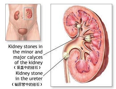 肾结石患者典型案例