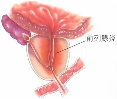 前“腺”告痛，个性疗法分型分治