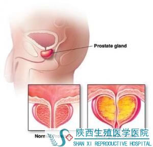前列腺肥大的症状有哪些