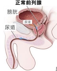 慢性前列腺炎能完全治愈吗