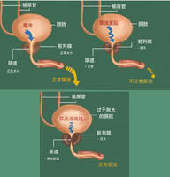 如何预防前列腺增生