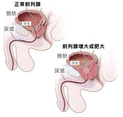 前列腺肥大的早期症状