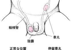 隐睾症的图片