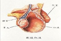 鞘膜积液的图片