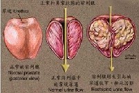 前列腺增生的图片