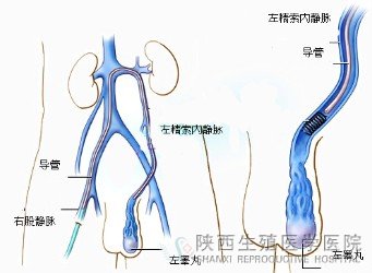 精索静脉曲张你了解吗？